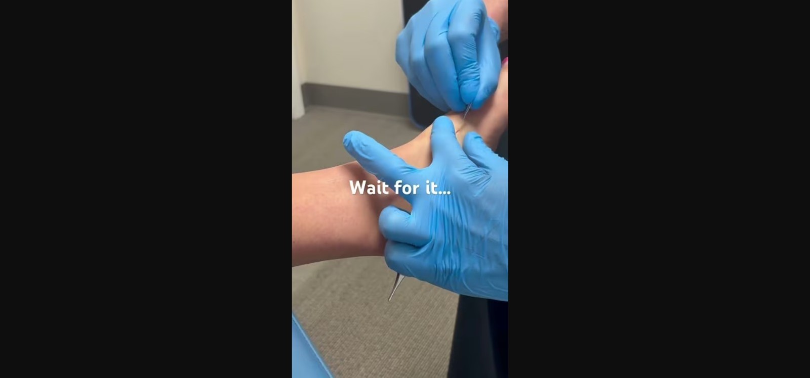 Sea-Urchin-Spine-Removal