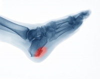 Facts About Heel Spurs