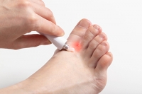 Is Athlete's Foot Contagious?