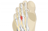 Pebble Sensation May Indicate Morton’s Neuroma