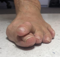 The Cause of Painful Foot Deformities